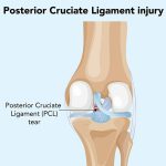 cedera ligamen lutut belakang