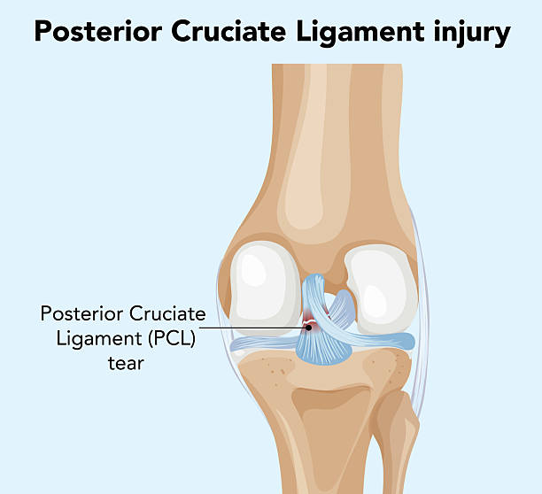 cedera ligamen lutut belakang