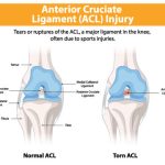 cedera ligamen lutut depan