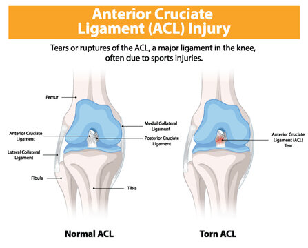 cedera ligamen lutut depan