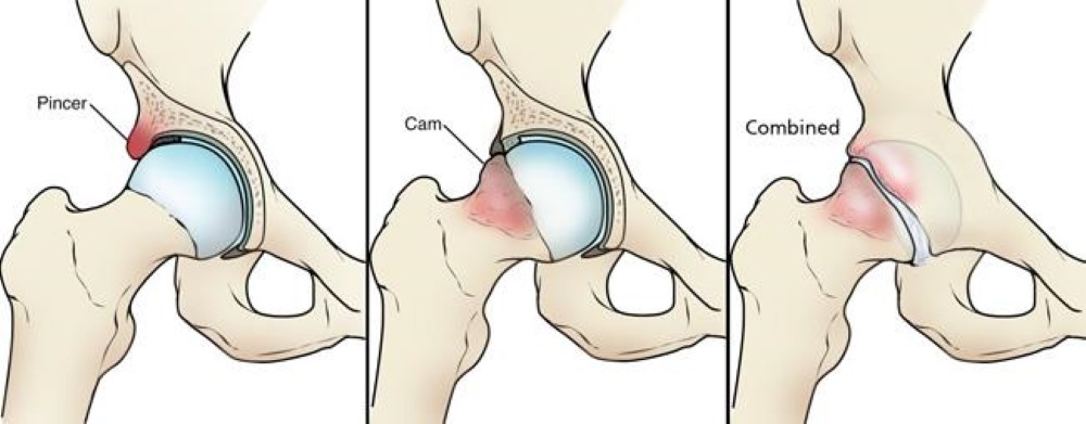 femoroacetabular impingement