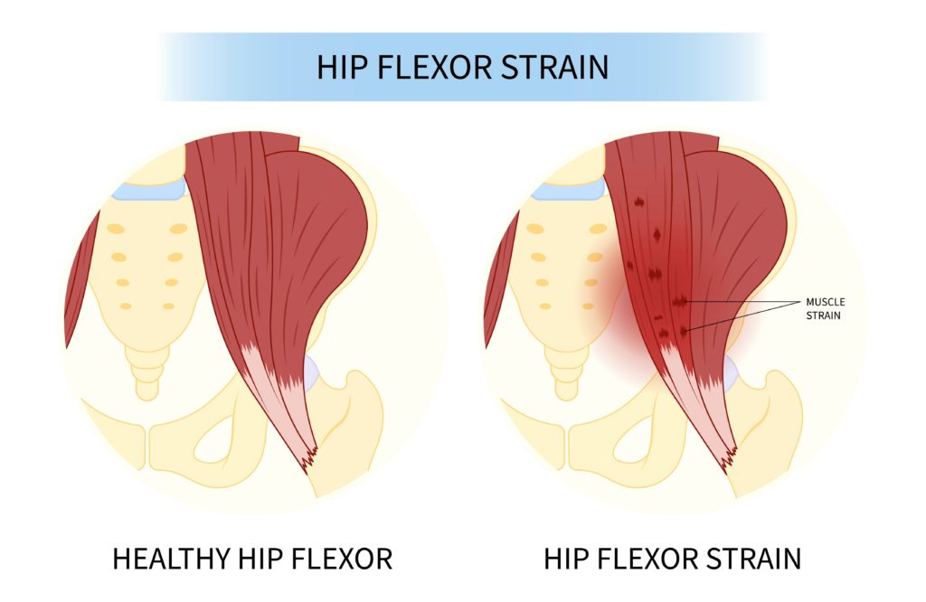hip flexor strain