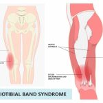 iliotibial band syndrome