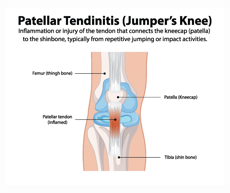 jumper's knee
