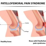 patellofemoral pain syndrome