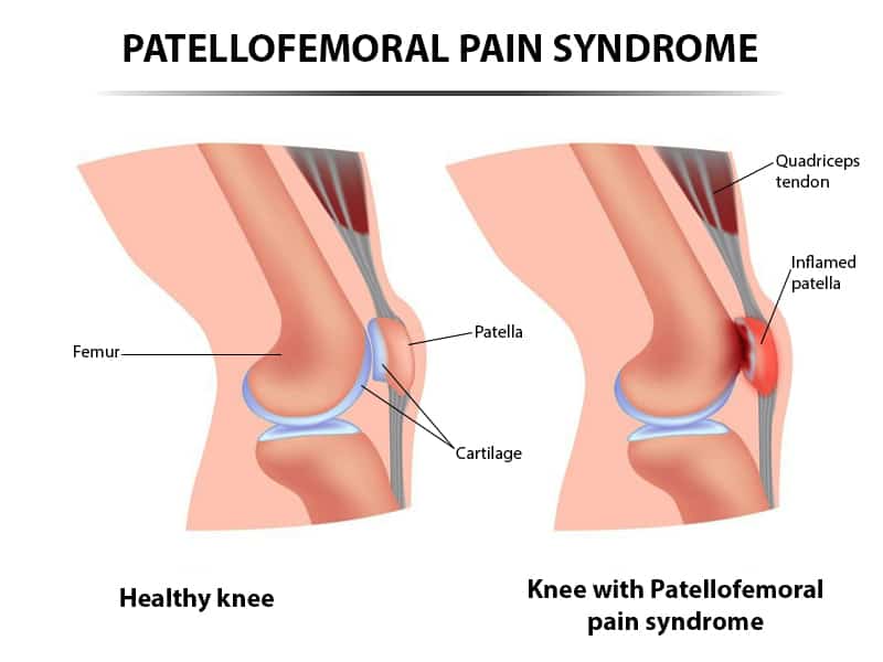 patellofemoral pain syndrome