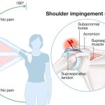 Shoulder Impingement Syndrome