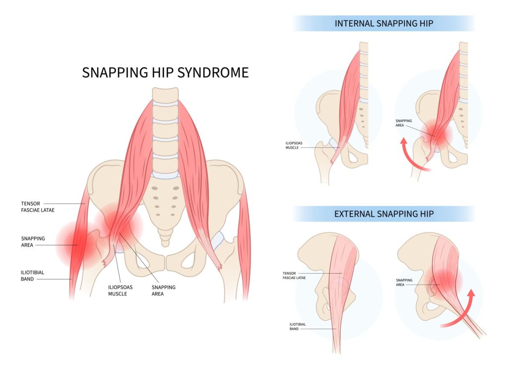 snapping hip syndrome