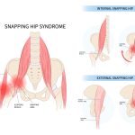 snapping hip syndrome