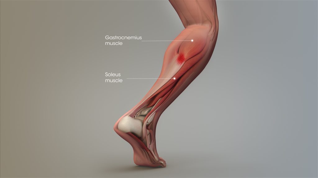 tennis leg